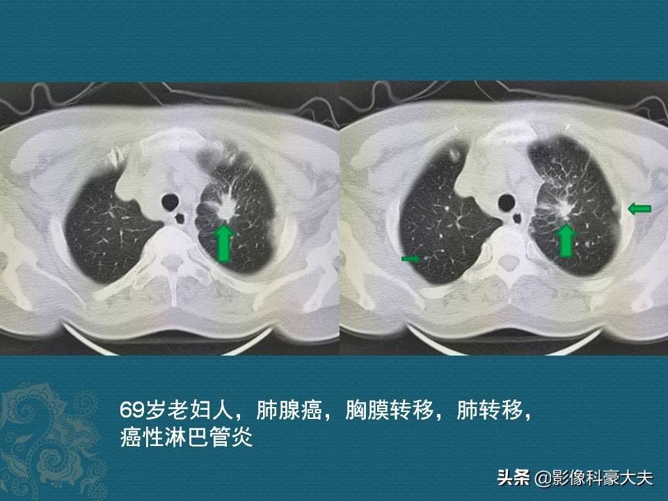 肺癌晚期的肿瘤有多大,肺癌晚期患者肿瘤一般是多大