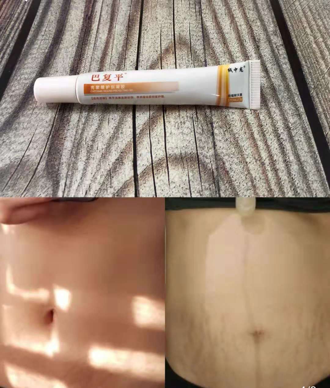 去妊娠纹修复测评推荐,去妊娠纹产后修复排行榜