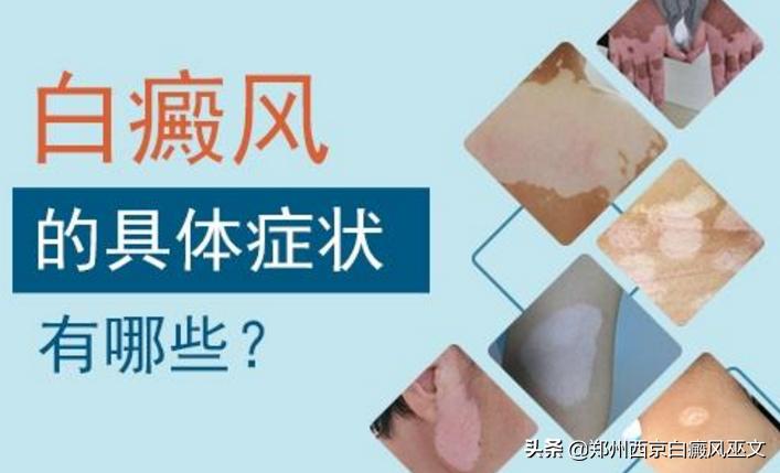 身上的白斑点怎么确定是白癜风,怎么辨别身上的斑块是不是白癜风