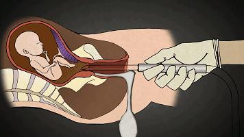 25岁的女生有几次打胎,女子堕胎6次连医生都惊讶了