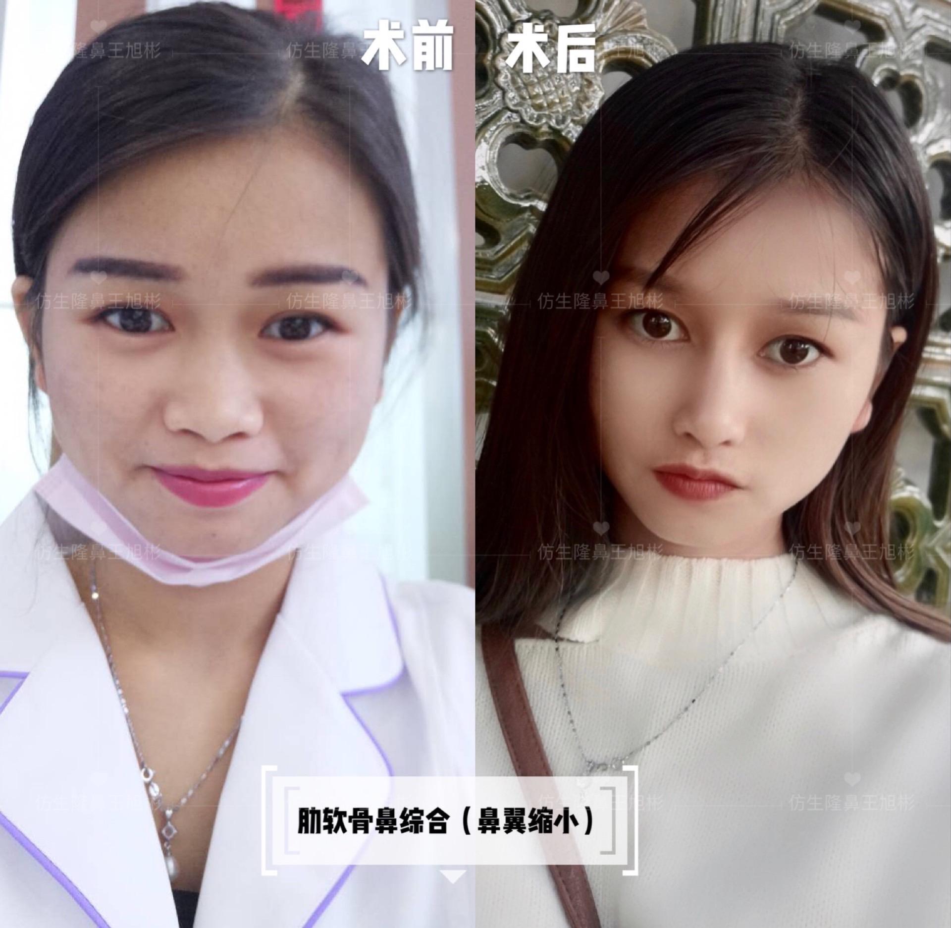 山根低鼻头大隆鼻,鼻根很低的隆鼻后的效果