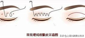 内双怎么变双眼皮整形手术多少钱,内双双眼皮适合哪种手术