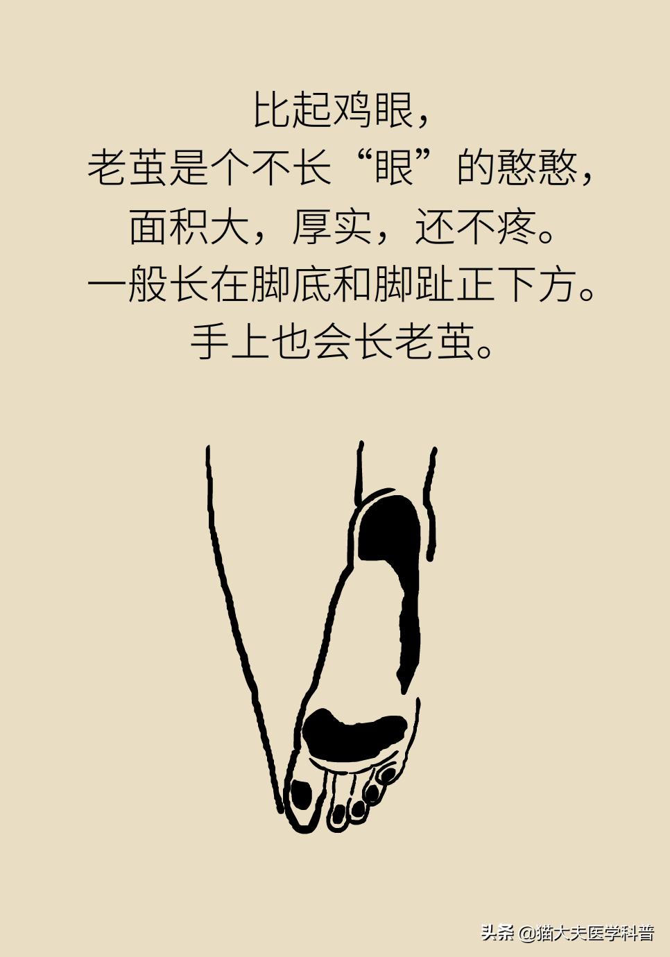 鸡眼好了长了一层老茧,鸡眼与老茧的区别图片