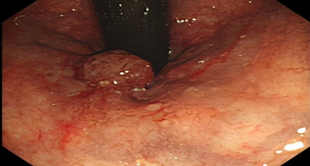 低位直肠癌保肛手术不造瘘利弊,低位直肠癌保肛会影响复发率么