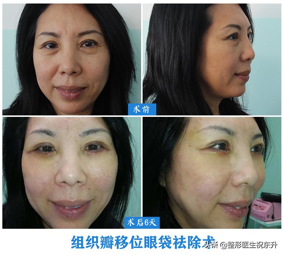 做眼袋手术的费用，听说中年人比年轻人要偏贵？有了解的谈一谈