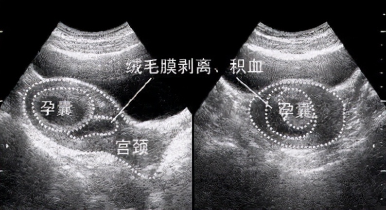 受精卵着床有啥感觉？孕中期出血为啥？