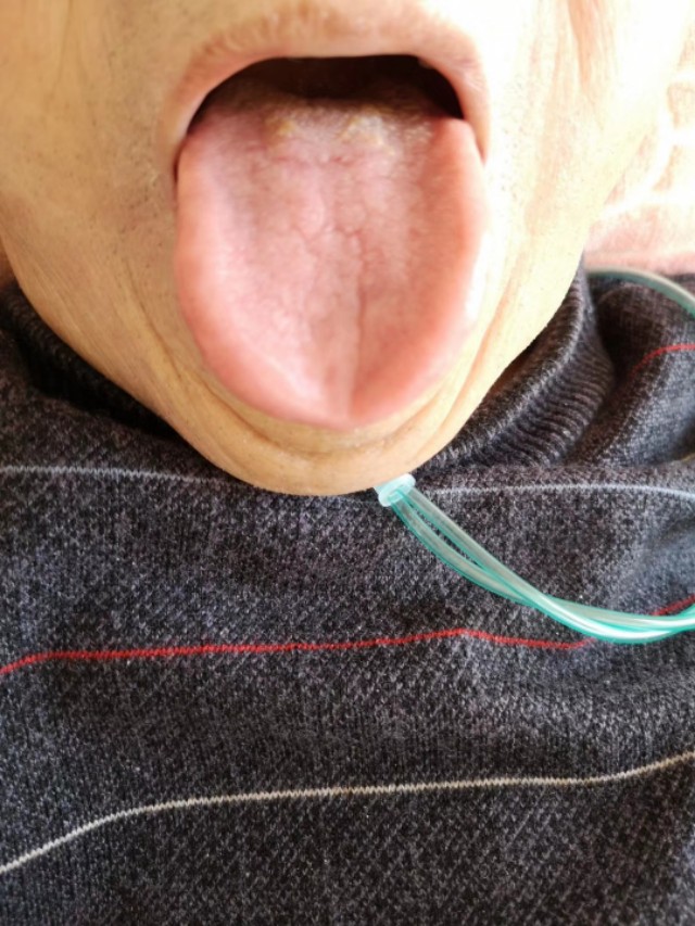 中西医结合治疗原因不明肠梗阻、腹水转氨酶明显升高病案一例！