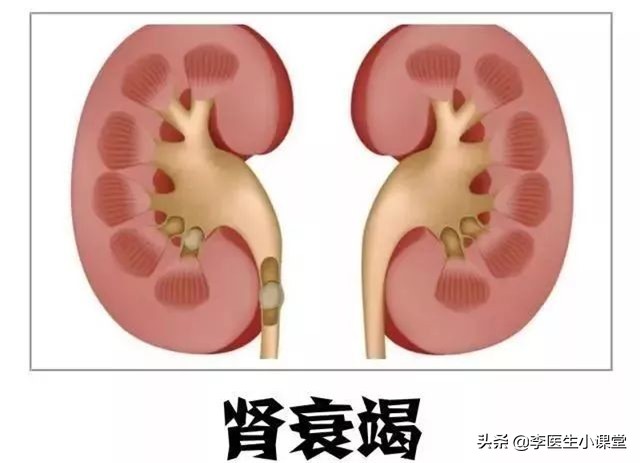 医生推荐一个动作根治痛风,治疗痛风不要只盯着尿酸看