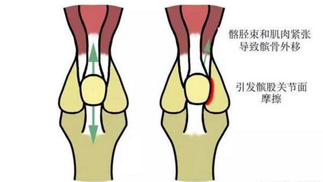 下蹲时膝关节疼痛可能是什么原因,膝关节下蹲到底时疼