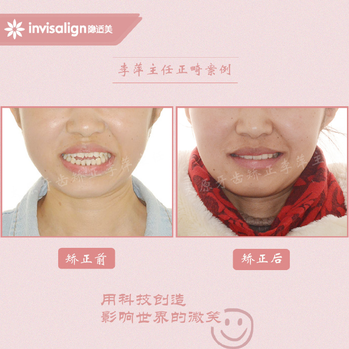 成都牙齿有缝隙怎么矫正,牙齿拥挤矫正前两天不痛正常吗