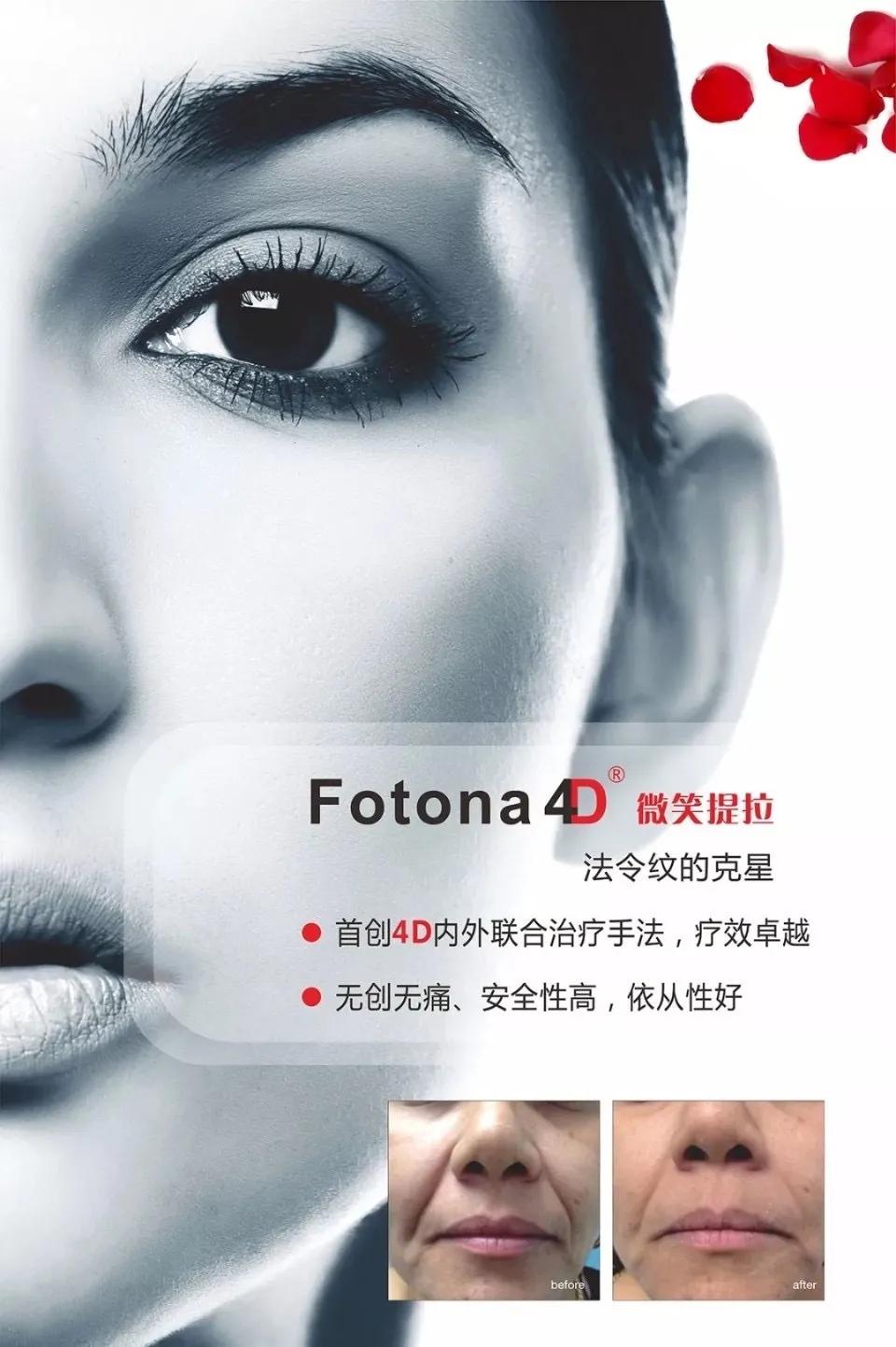 fotona4d效果真的好吗,fotona4d真的有效果吗