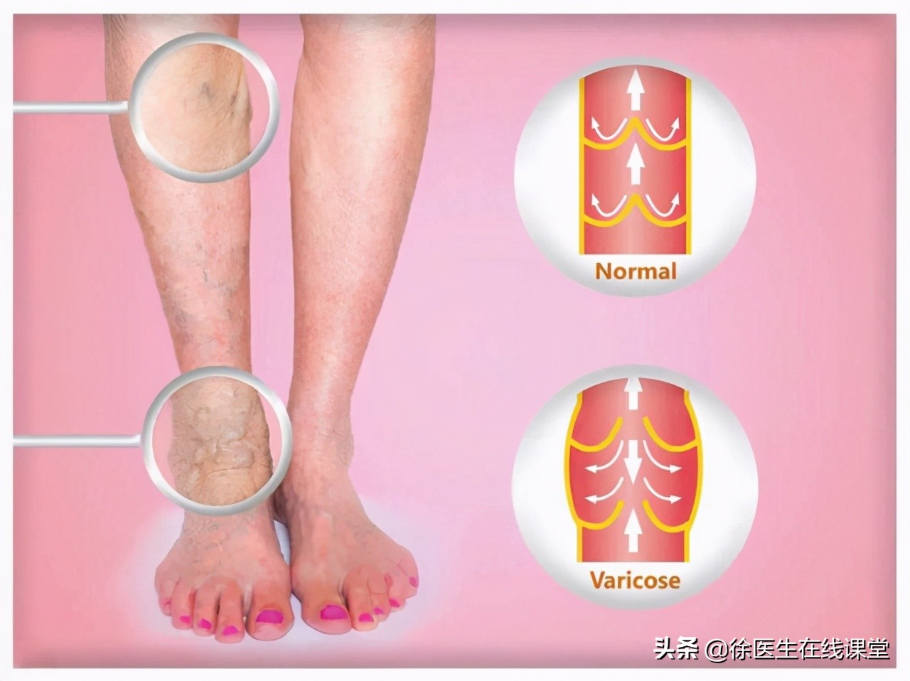 肝硬化食道胃底静脉曲张破裂出血,肝硬化消化道出血静脉曲张的治疗