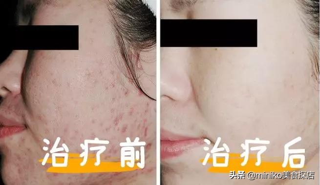 祛痘、脱毛、洗牙？点开这篇文章，离女神更近一步