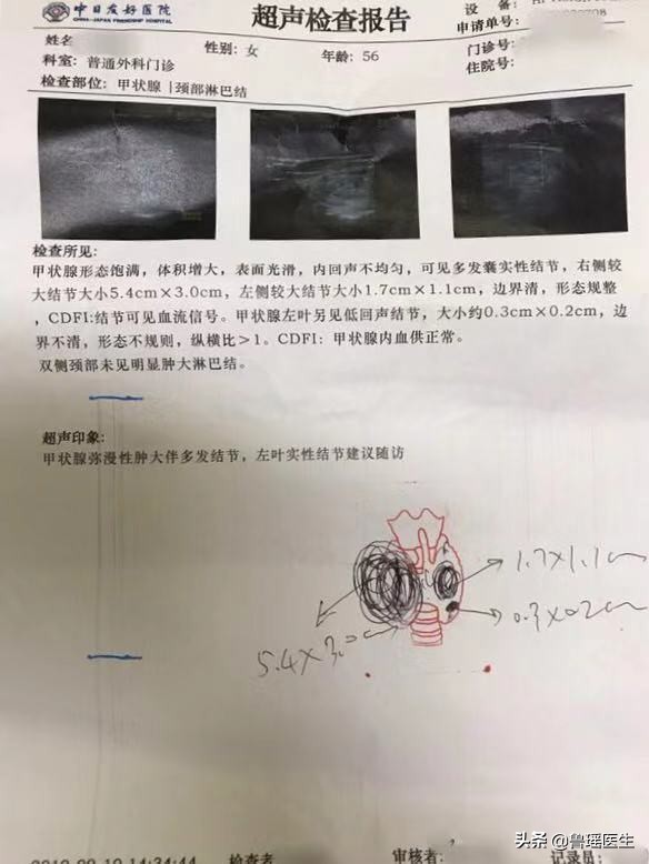 拖延回避、吃中药转了一圈后这位甲状腺结节患者还是选择了手术