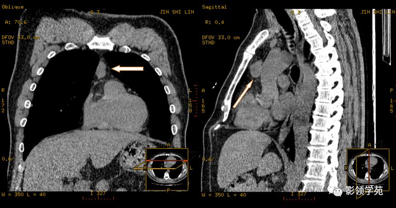 纵隔和肾上腺恶性肿瘤,纵隔性肿瘤位置图