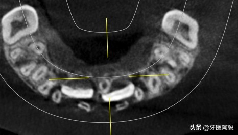 儿童多生牙全景图片，什么时候拔除比较合适