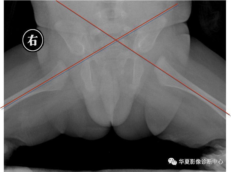 先天性髋关节脱位截骨术全过程,先天性髋关节脱位可以考驾驶证吗