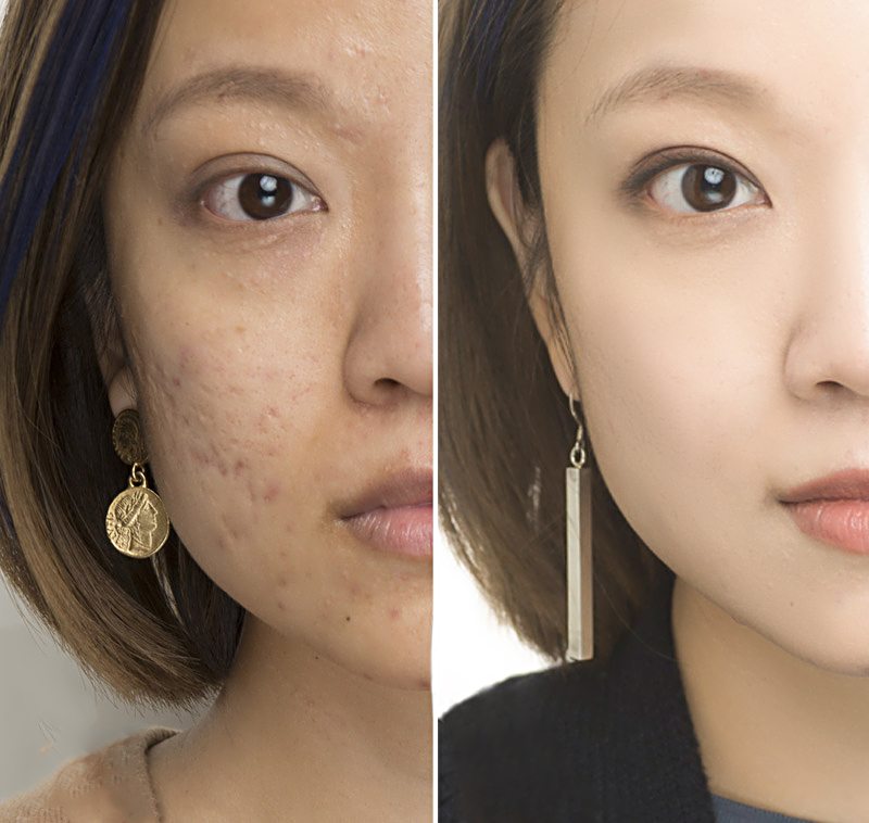 青春痘祛痘方法小妙招,青春痘快速消除方法视频