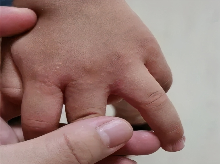 天一热手上就起一层小疙瘩还很痒,两只手上长密集的小疙瘩很痒很红