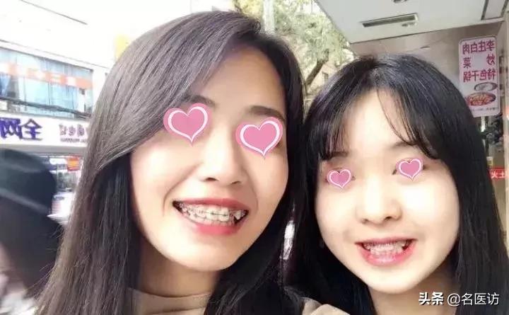 矫正牙齿后牙掉了,矫正牙齿只拔上面2颗牙