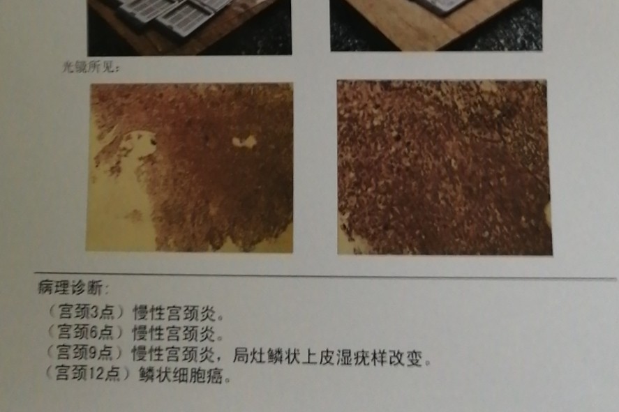 如何发现早期的宫颈癌,怎么发现宫颈癌的