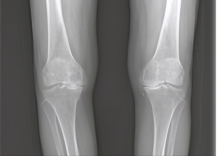 骨科医生教你一招搞定膝盖痛,不同部位膝关节