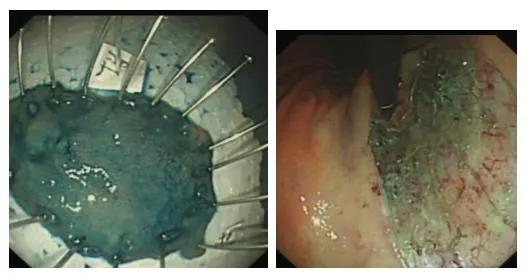 ESD术后出血?饮食很重要