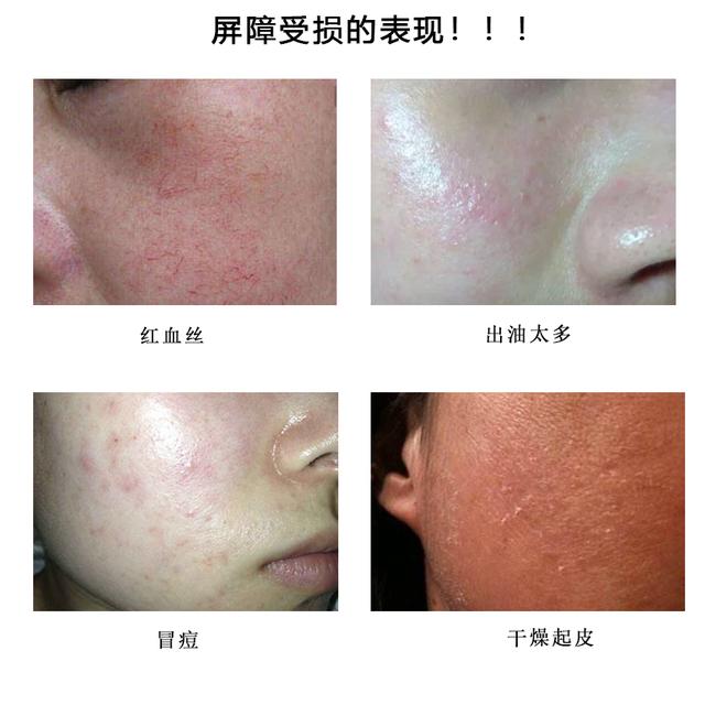 戴口罩脸颊泛红长痘,敏感皮肤戴口罩长了很多痘