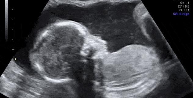 胎儿在母亲的肚子无脚乱踢,腹中胎儿猛踢肚子