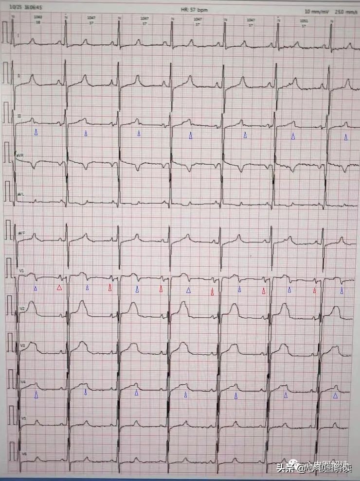 加速性房室交界性心律治疗,2:1房室传导阻滞