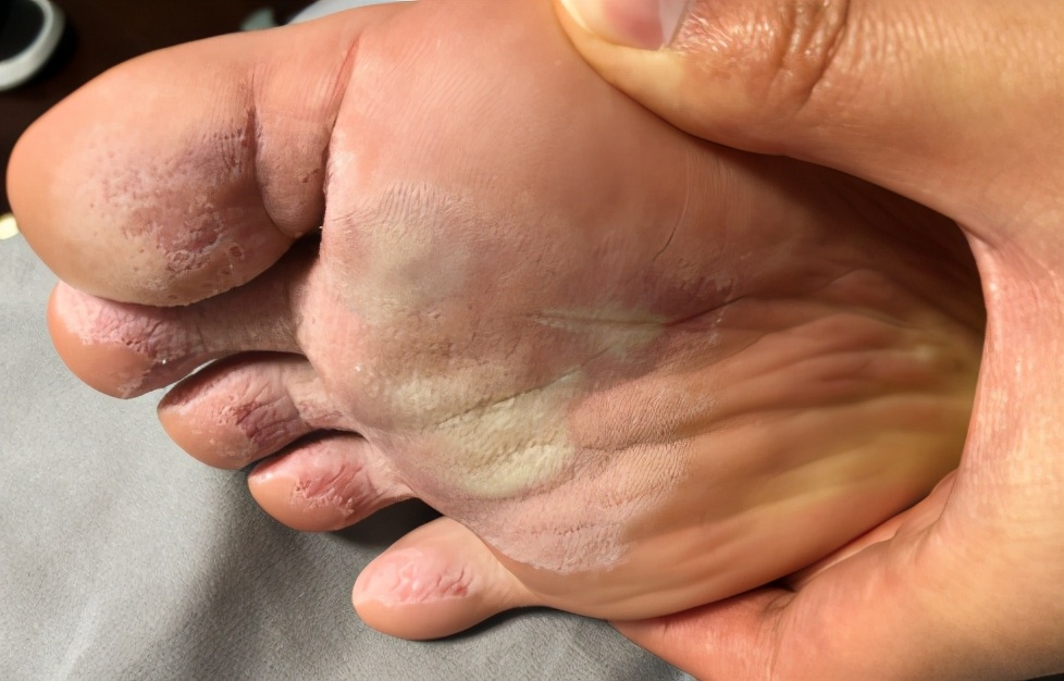 足癣是否会脚臭,足癣和脚臭什么区别