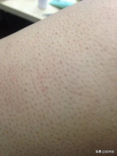 如何预防闭口长出并解决闭口问题,教你5个根治闭口粉刺方法