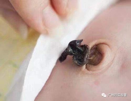 新生婴儿溶血性黄疸怎么照顾,新生儿溶血性黄疸护理月嫂