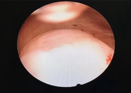 乐山市中医医院妇科大力开展冷刀宫腔镜手术治疗