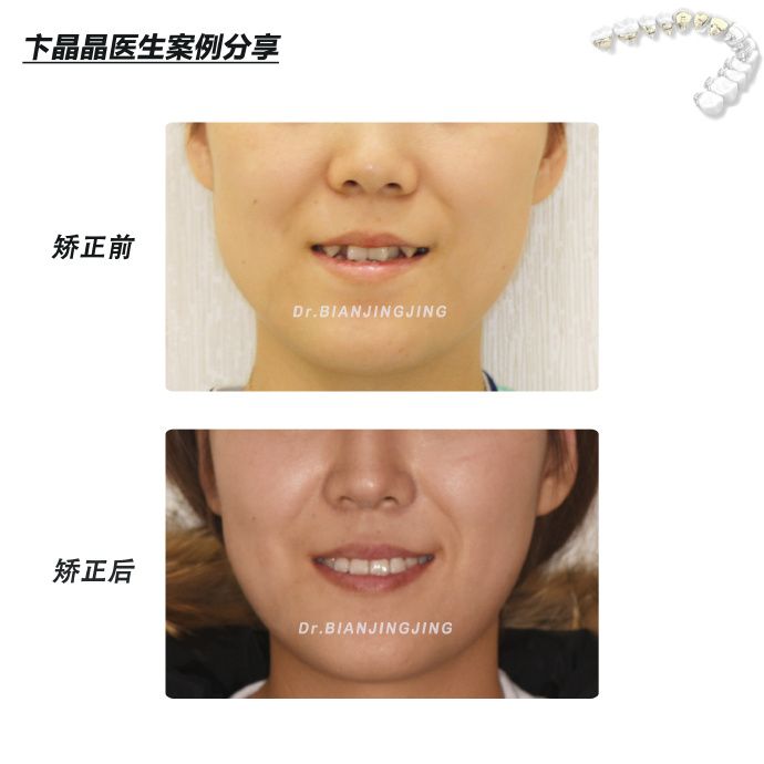 沈阳矫正牙齿大概多久能矫正过来,沈阳牙齿代偿矫正哪里好