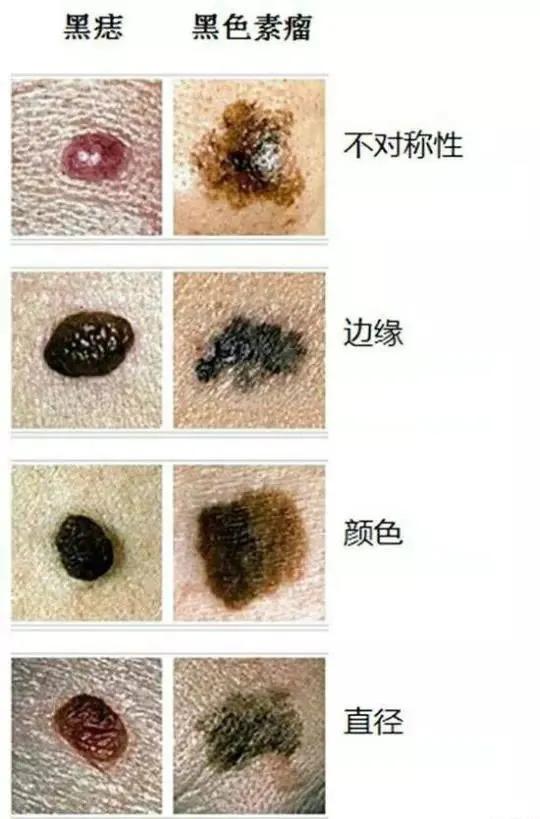 痣癌变后就是黑色素瘤吗,癌变痣是叫黑色素瘤吗