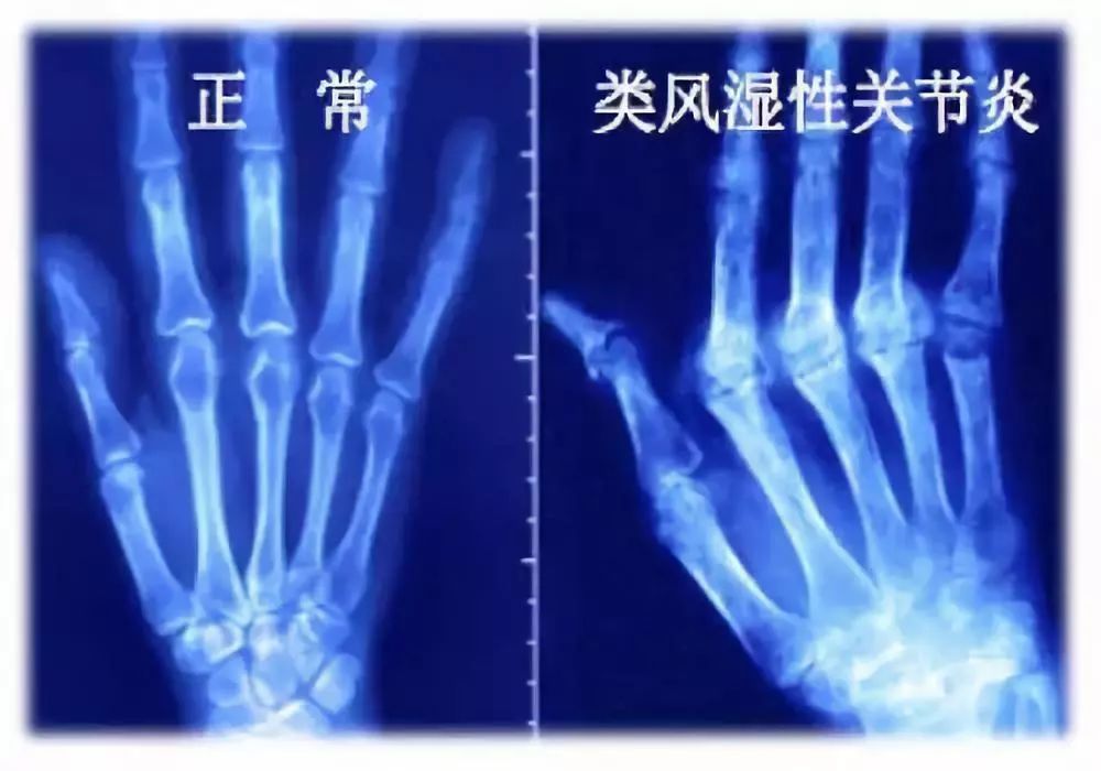 髋关节疼有哪几种原因,髋关节痛如何能确诊什么原因引起