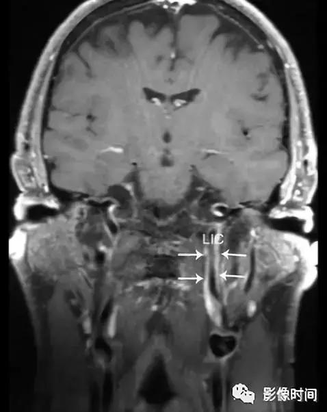 双侧颈动脉鞘间隙多发小淋巴结影,双侧颈动脉间隙多软组织密度结节