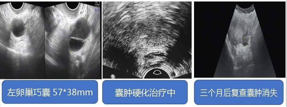 【新技术】红兴隆中心医院超声科|囊肿硬化治疗—针尖上的艺术囊肿患者的福音
