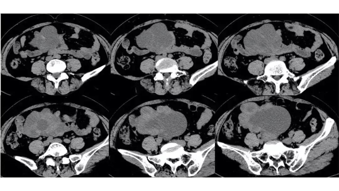 卵巢原发肿瘤的分析思路