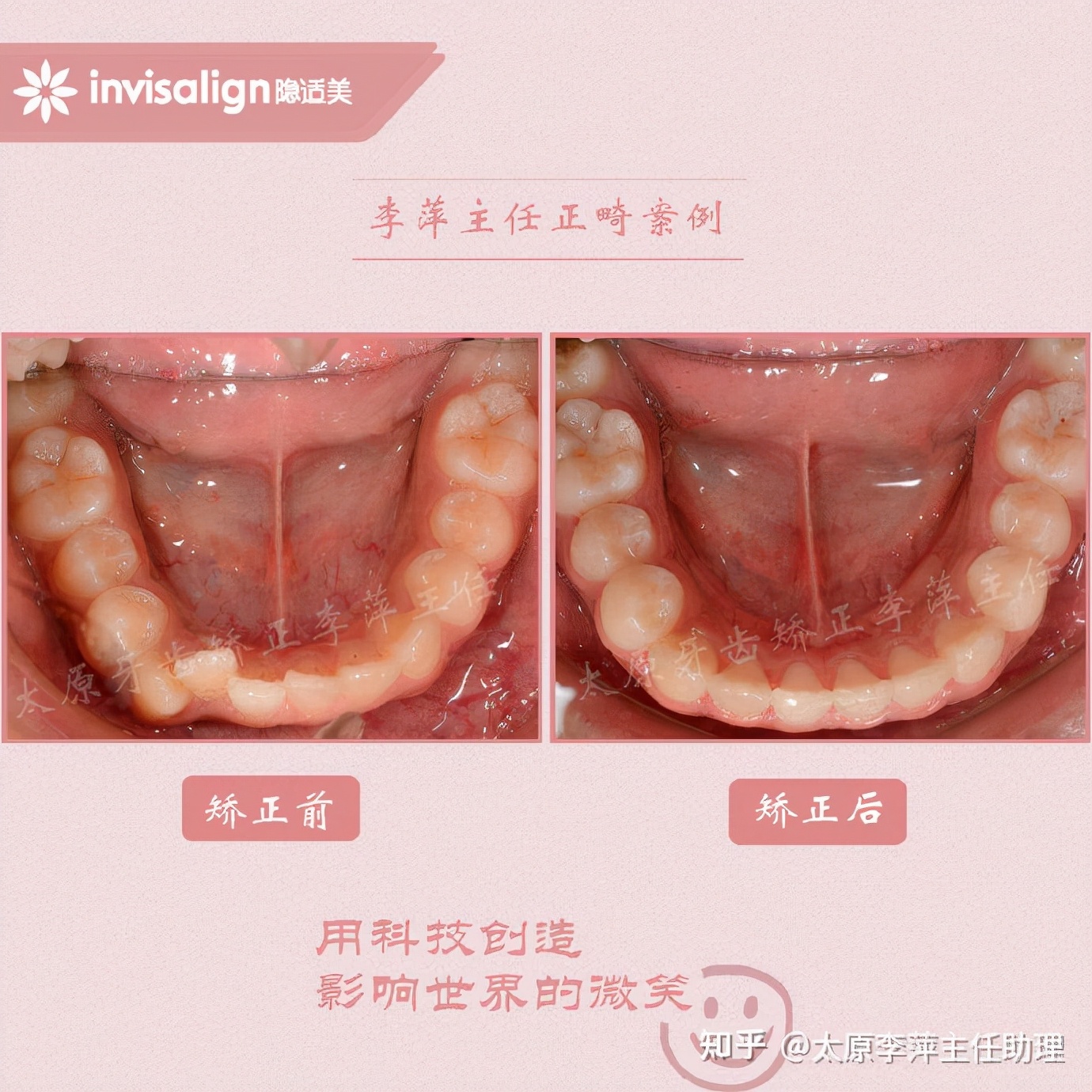 重度拥挤矫正牙齿适合隐形牙套吗,广州成人牙齿矫正推荐隐形牙套