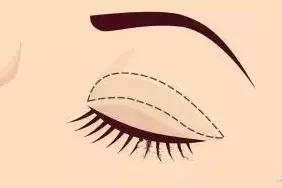 割双眼皮埋线和全切有什么区别,全切双眼皮内眼角割的不一样