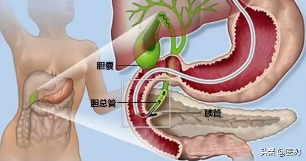 胆结石手术后可以预防胆管结石吗,胆囊结石和胆结石哪个严重一点