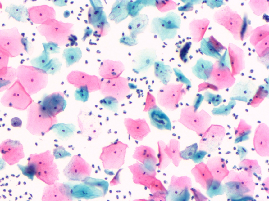 你们医生讲话这么复杂，宫颈癌筛查CIN1级到底要不要治？