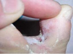 春天来了脚丫奇痒无比怎么办,手脚奇痒无比怎么缓解