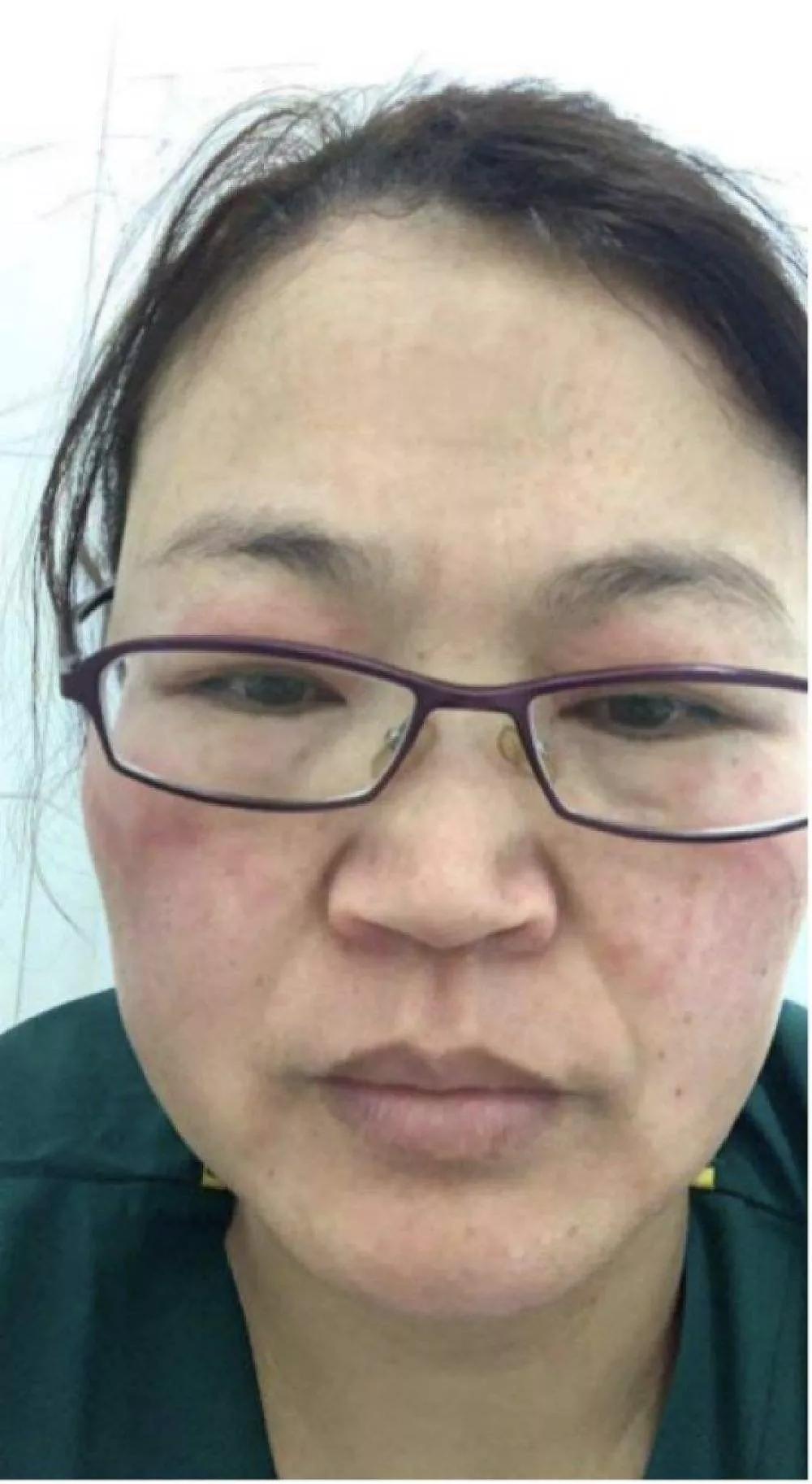 戴口罩脸上痘痘怎么快速消除,戴口罩长痘如何正确护理