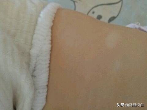 水泡变成白癜风,水泡变成小红点