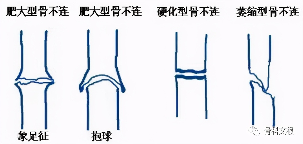 骨折了怎么一直不消肿吃什么药,骨折延缓愈合和骨不连的区别在哪