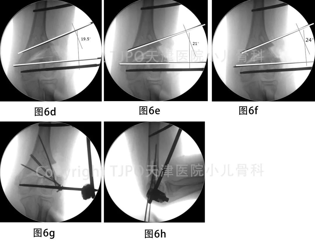 肱骨髁上骨折如何预防肘外翻畸形,肱骨髁上骨折外翻畸形原因