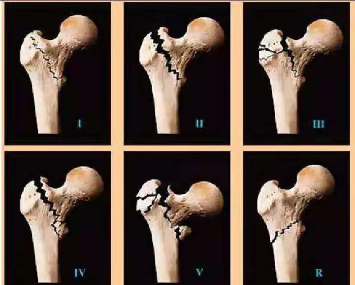 股骨大转子骨折手术后淤血正常吗,股骨粗隆骨折出血多吗